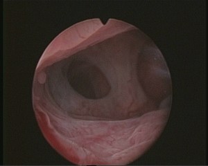 Hysteroscopy Newsletter