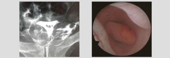 Hysteroscopy newsletter