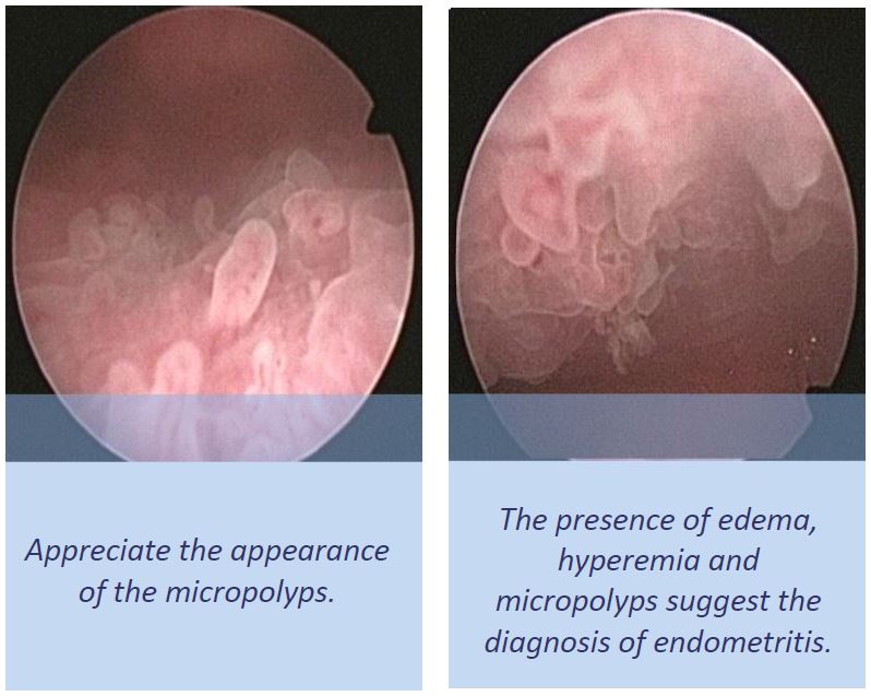 Chronic endometritis