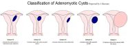 Hysteroscopic Treatment Of Submucous Cystic Adenomyosis Hysteroscopy 