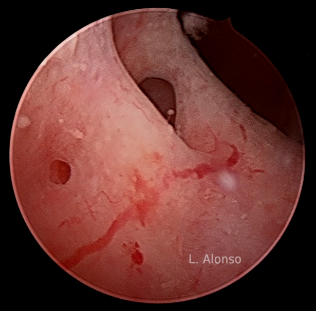 Adenomyosis: A Review